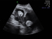 Abb. 2: Uterus subseptus