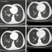 Abb. 1A-D: Pulmonalembolie