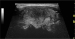 Abb. 3: Subakute Thyreoiditis