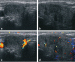 Abb. 6a-d: Subakute Thyreoiditis