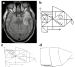 Abb. 2a-d: Amnestisches Syndrom