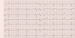 Abb. 1: EKG