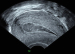 Aktuelles Bild - Abb. 2: Ultraschall-Serometra