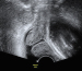 Abb. 10: Ultraschall-Serometra