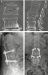 Abb. 2a-b: Osteoporotische Wirbelkörperfraktur