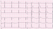 Aktuelles Bild - Abb. 1: EKG
