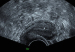 Abb. 1: Subendometriale Fibrose