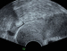 Abb. 6: Subendometriale Fibrose
