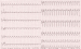 Abb. 1: EKG - Aufnahme