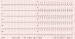Abb. 3: EKG - Adenosin 