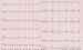 Abb. 4: EKG - Sedacoron