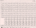 Abb. 1: EKG - Aufnahme