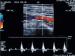 Abb. 17: Duplexsonographie - Pulsdoppler