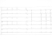 Aktuelles Bild - Abb. 1: EKG