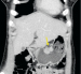 Abb. 1a: Antrum-Karzinom