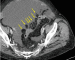 Abb. 1d: Appendices epiploicae