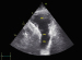 Abb. 4: Pulmonalarterie