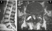 Abb. 2a-b: Vertebrostenose