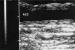Abb. 15: Duplexsonographie - Intima-Media