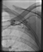 Abb. 4: Präinterventionelle Angiographie