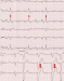 Abb. 1: Ventricular premature beats