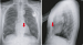 Abb. 2: Pacemaker leads