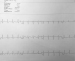 Abb. 1: EKG