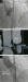 Aktuelles Bild - Abb. 1a-c: Valve implantation