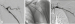 Abb. 7A-C: Perkutane transluminale Angioplastie