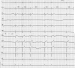 Aktuelles Bild - Abb. 1: Sinusrhythmus mit Pausen