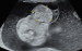 Abb. 2: Omphalocele