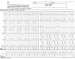 Abb. 1: EKG - klinische Symptomatik