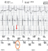 Aktuelles Bild - Abb. 2: Intrakardiales EKG
