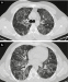 Abb. 4a-b: Thorax-CT