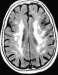 Abb. 2: White Matter Läsionen