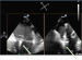 Abb. 4a-b: MitraClip®-Implantation