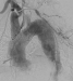 Abb. 2: Produkt: Stentgraft<br>
Vertrieb: Jotec GmbH