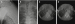 Abb. 11A-D: Perkutane Insertion