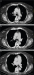 Aktuelles Bild - Abb. 2a-c: Thorax-CT