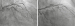 Aktuelles Bild - Abb. 2: LAD-Stenose