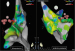 Abb. 4: Aktivierungs-MAP - LVOT