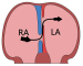 Abb. 1: Vorhofseptum