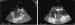 Abb. 3: PFO