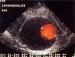 Abb. 8: Duplexsonographie - A. abdominalis - Aneurysma
