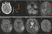 Abb. 3: Neuritis vestibularis 