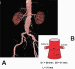 Abb. 1: Aortenaneurysma