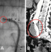 Abb. 5: EndoAnchor-Implantation