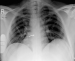 Abb. 2: Chest x-Ray