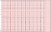 Aktuelles Bild - Abb. 1: EKG