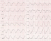 Aktuelles Bild - Abb. 1: EKG